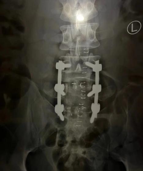 打了6根钉子的脊柱/受访者供图
